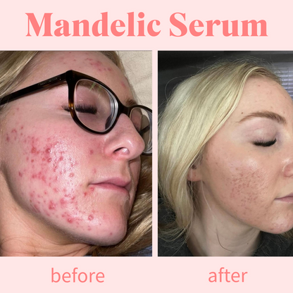 Mandelic Serum 5%